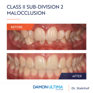 Maloclusión de Clase II subdivisión 2 con apiñamiento maxilar y mandibular significativo