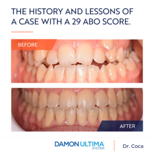 Teeth Before and After Damon Ultima